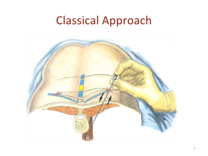 celiac-plexus-block celiac-plexus-block