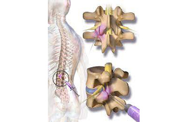 facet-joint-injection