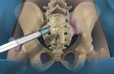 sacroiliac-joint