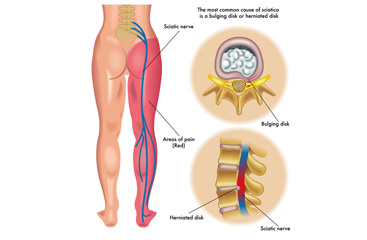 sciatica-pain sciatica-pain