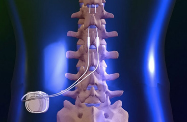 spinal-cord-stimulator