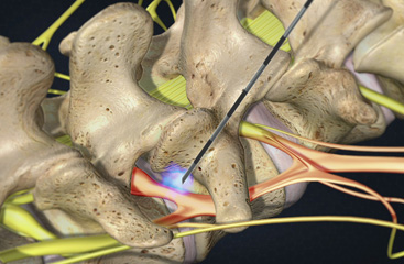 transforaminal-epidural transforaminal-epidural